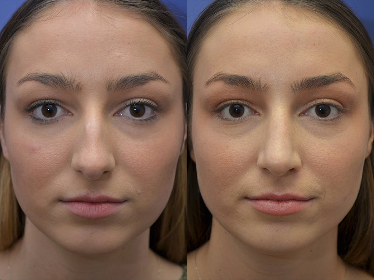 Rhinoplasty Before & After Gallery - Patient 205286 - Image 3