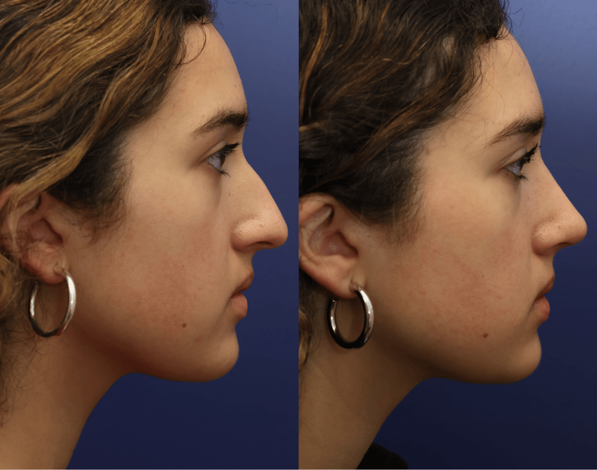 Rhinoplasty Before & After Gallery - Patient 392537 - Image 1