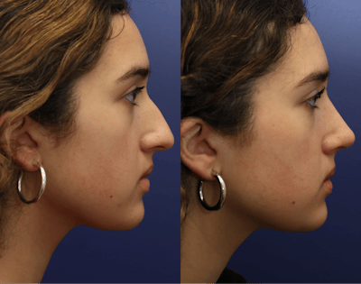 Rhinoplasty Before & After Gallery - Patient 392537 - Image 1
