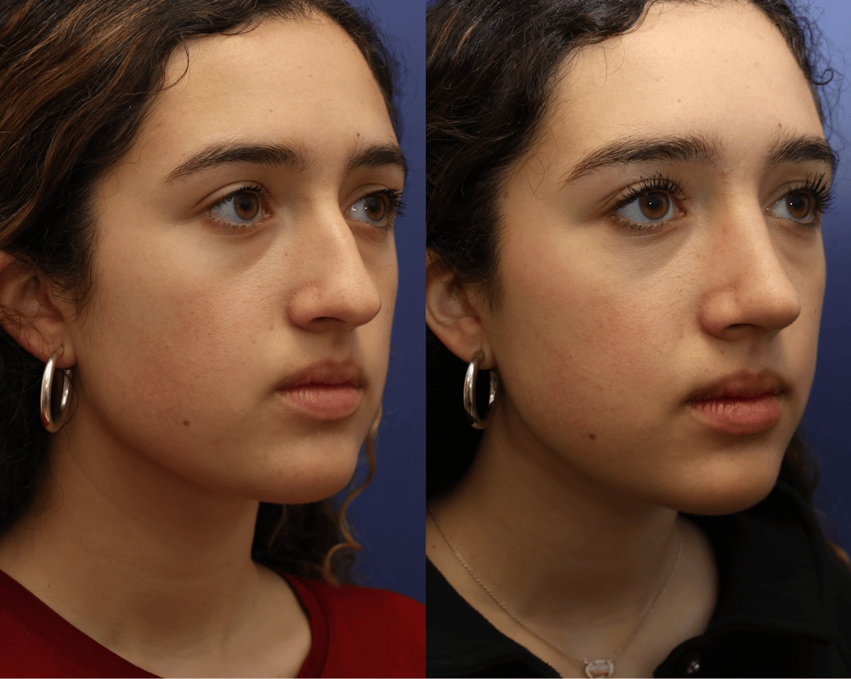 Rhinoplasty Before & After Gallery - Patient 392537 - Image 2