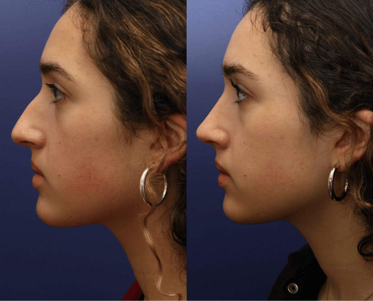 Rhinoplasty Before & After Gallery - Patient 392537 - Image 3