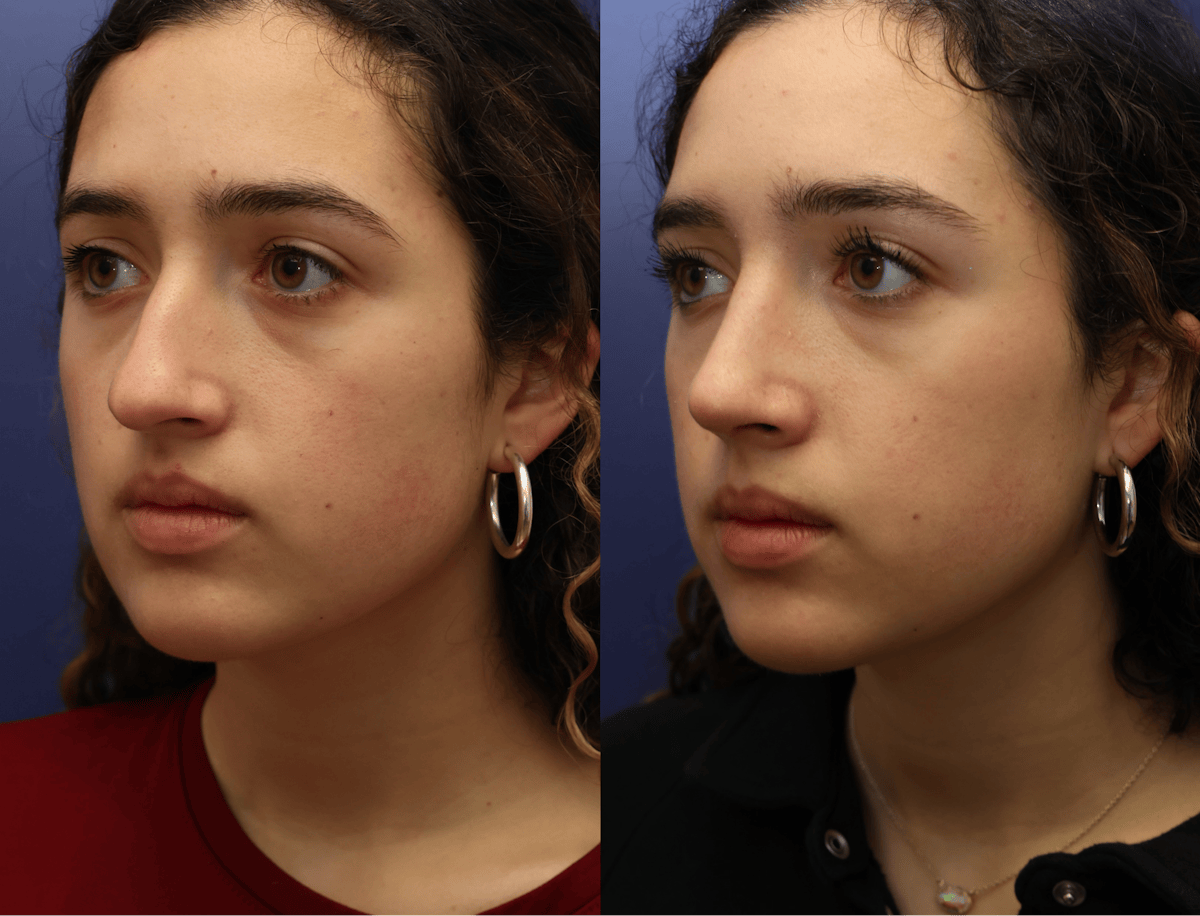 Rhinoplasty Before & After Gallery - Patient 392537 - Image 4