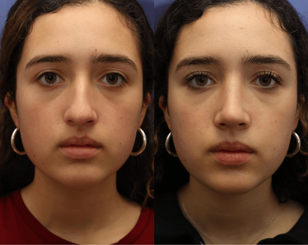 Rhinoplasty Before & After Gallery - Patient 392537 - Image 5