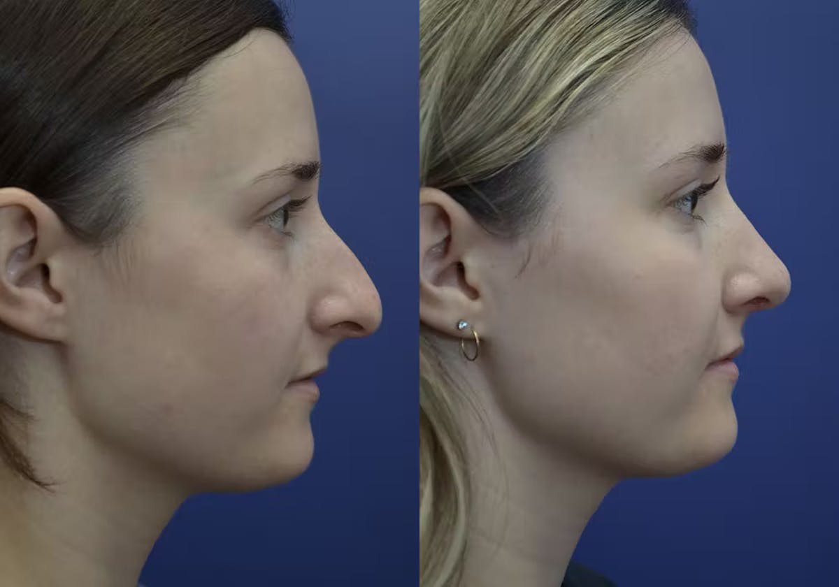 Rhinoplasty Before & After Gallery - Patient 296937 - Image 1