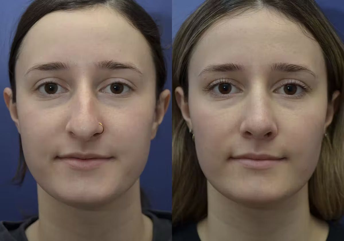 Rhinoplasty Before & After Gallery - Patient 296937 - Image 2