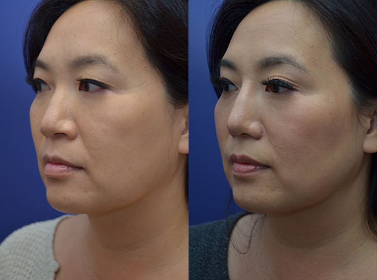 Alarplasty Before & After Gallery - Patient 149855 - Image 2