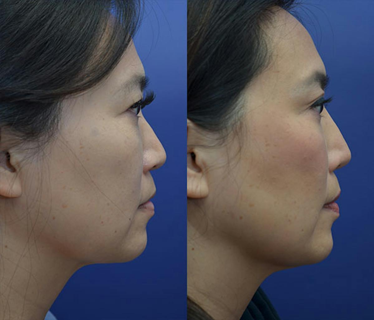 Alarplasty Before & After Gallery - Patient 149855 - Image 4