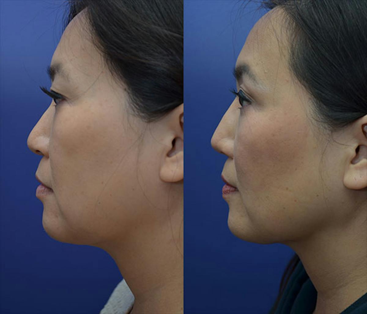 Alarplasty Before & After Gallery - Patient 149855 - Image 5