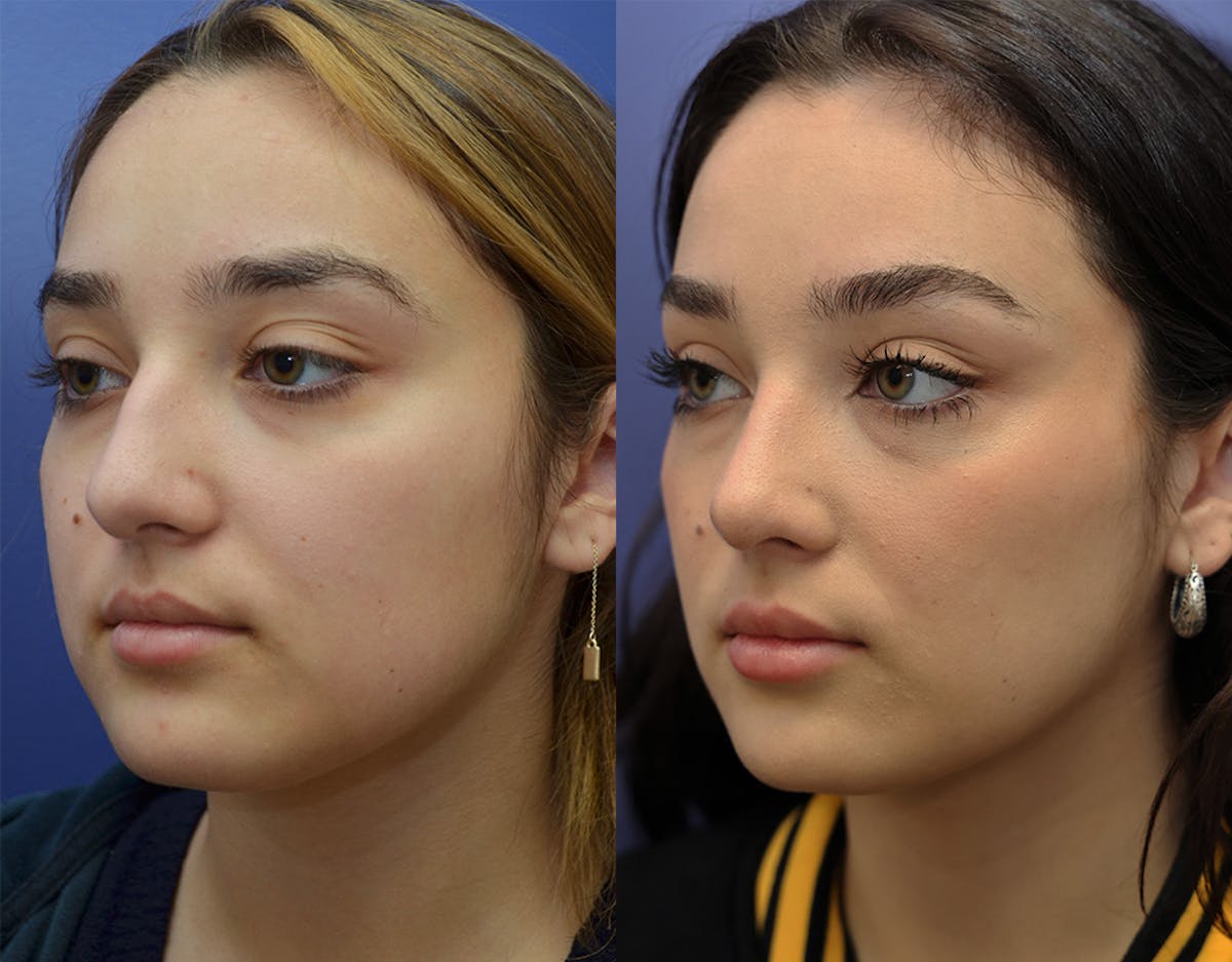 Rhinoplasty (Nose Reshaping Before & After Gallery - Patient 500512 - Image 1
