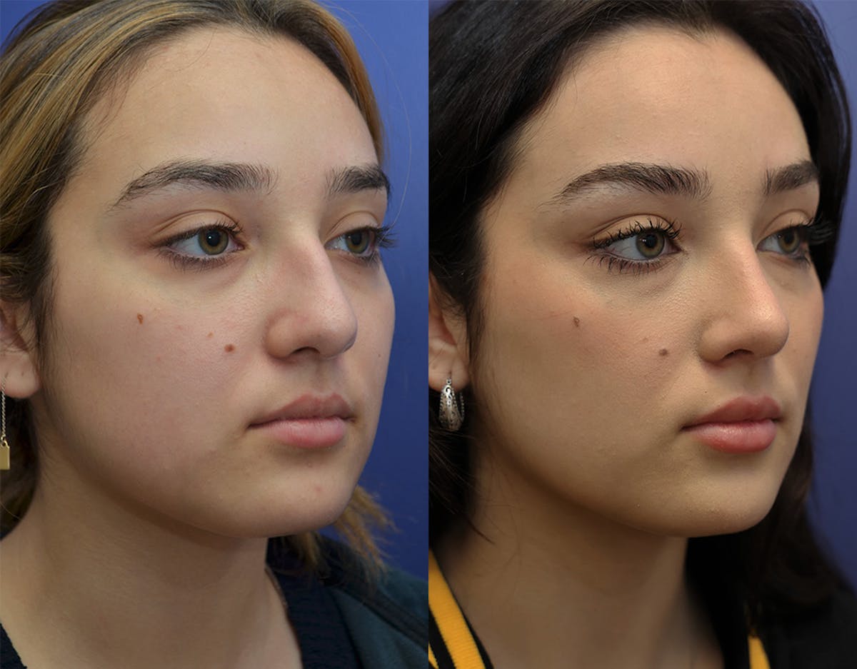 Rhinoplasty (Nose Reshaping Before & After Gallery - Patient 500512 - Image 2