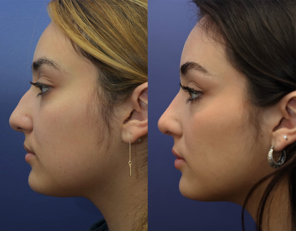 Rhinoplasty (Nose Reshaping Before & After Gallery - Patient 500512 - Image 3