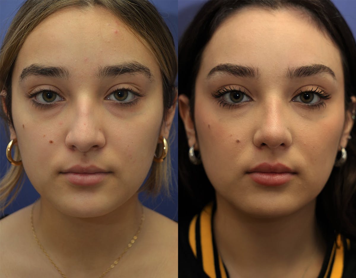 Rhinoplasty (Nose Reshaping Before & After Gallery - Patient 500512 - Image 5
