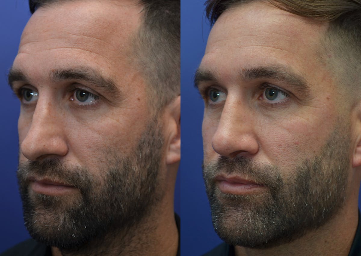 Rhinoplasty Before & After Gallery - Patient 184652 - Image 2