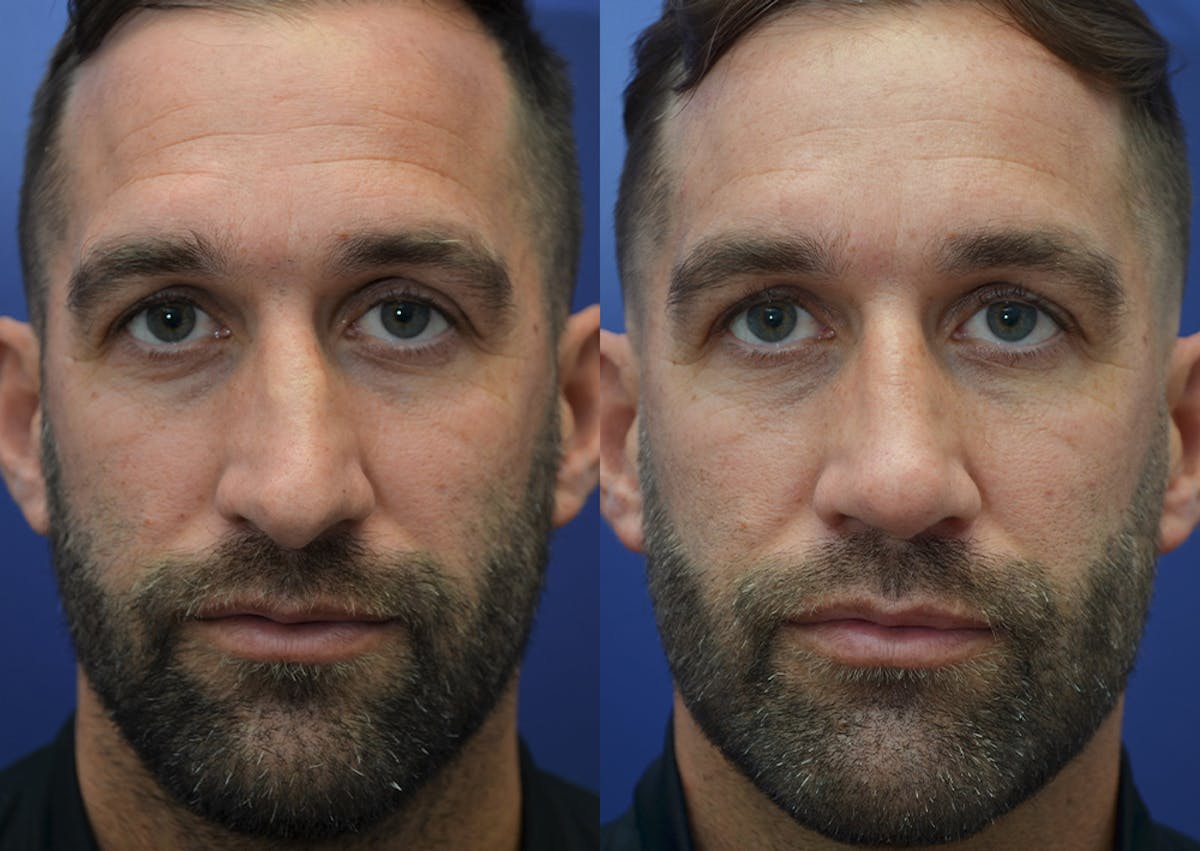 Rhinoplasty Before & After Gallery - Patient 184652 - Image 3