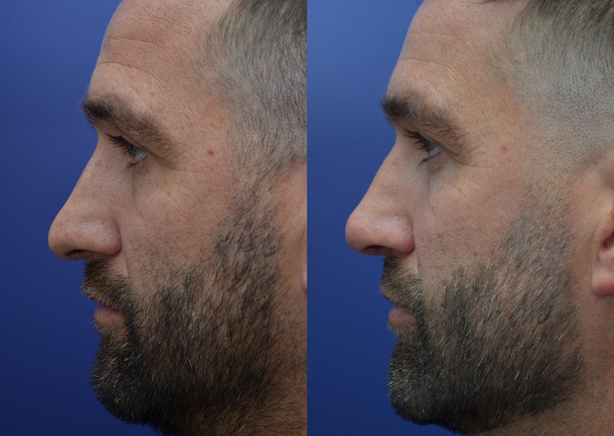 Rhinoplasty Before & After Gallery - Patient 184652 - Image 4