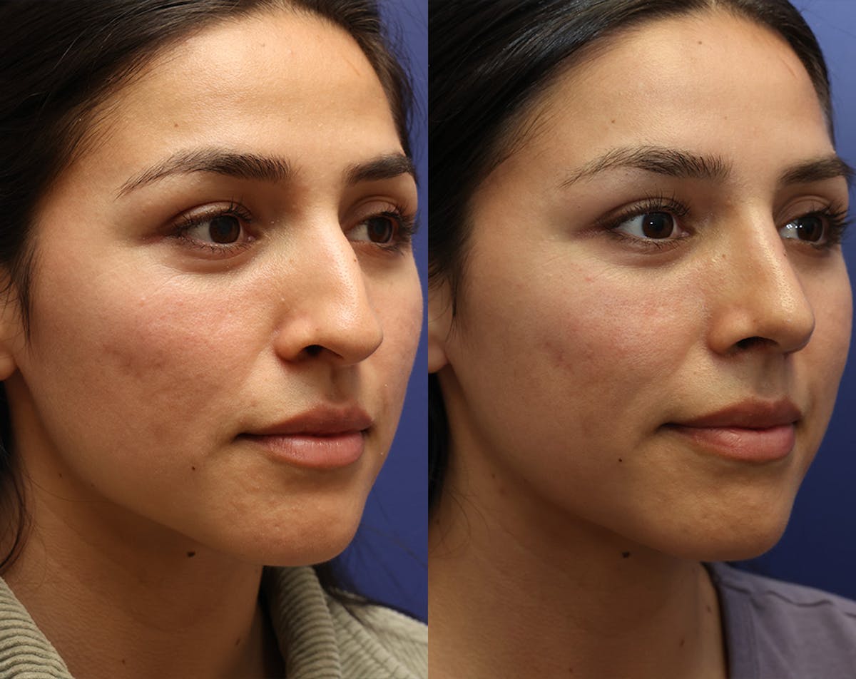 Rhinoplasty Before & After Gallery - Patient 227663 - Image 1