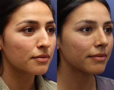 Rhinoplasty Before & After Gallery - Patient 227663 - Image 1