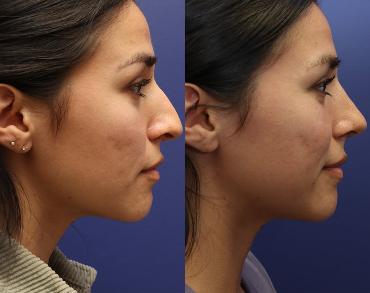 Rhinoplasty Before & After Gallery - Patient 227663 - Image 2