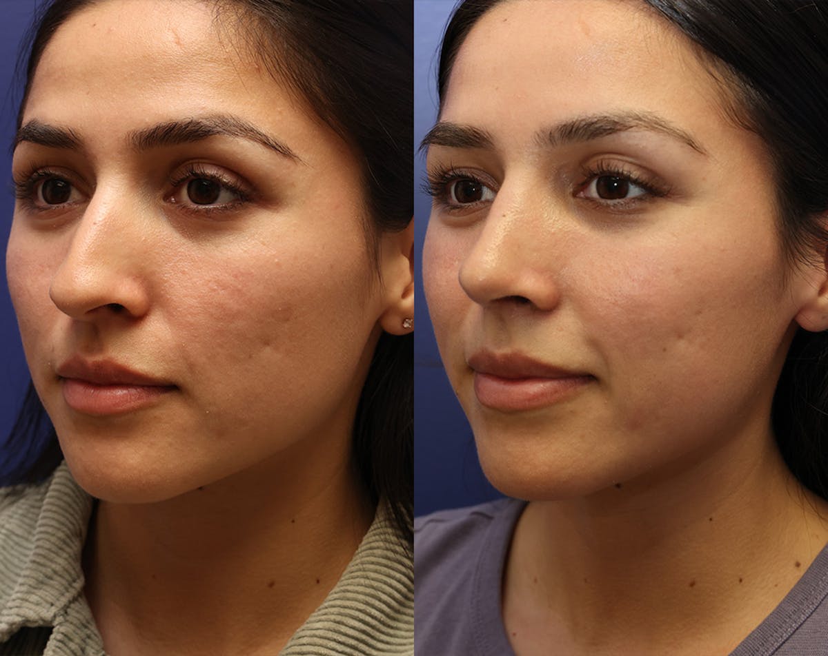 Rhinoplasty Before & After Gallery - Patient 227663 - Image 4