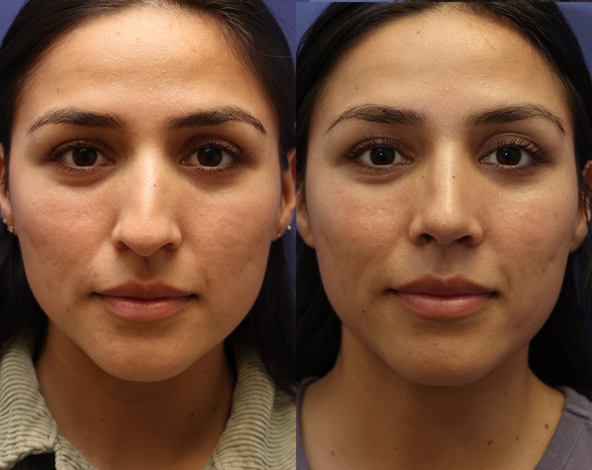 Rhinoplasty Before & After Gallery - Patient 227663 - Image 5