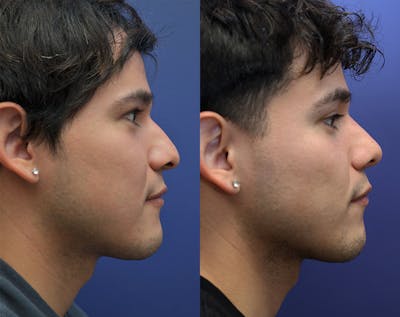 Rhinoplasty Before & After Gallery - Patient 371131 - Image 1