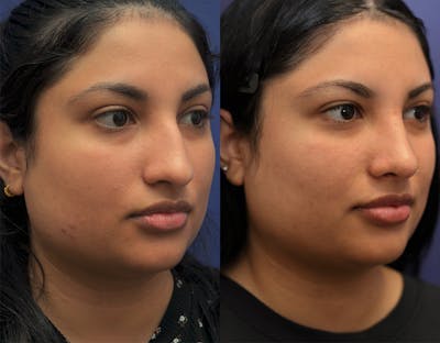 Rhinoplasty Before & After Gallery - Patient 276432 - Image 1