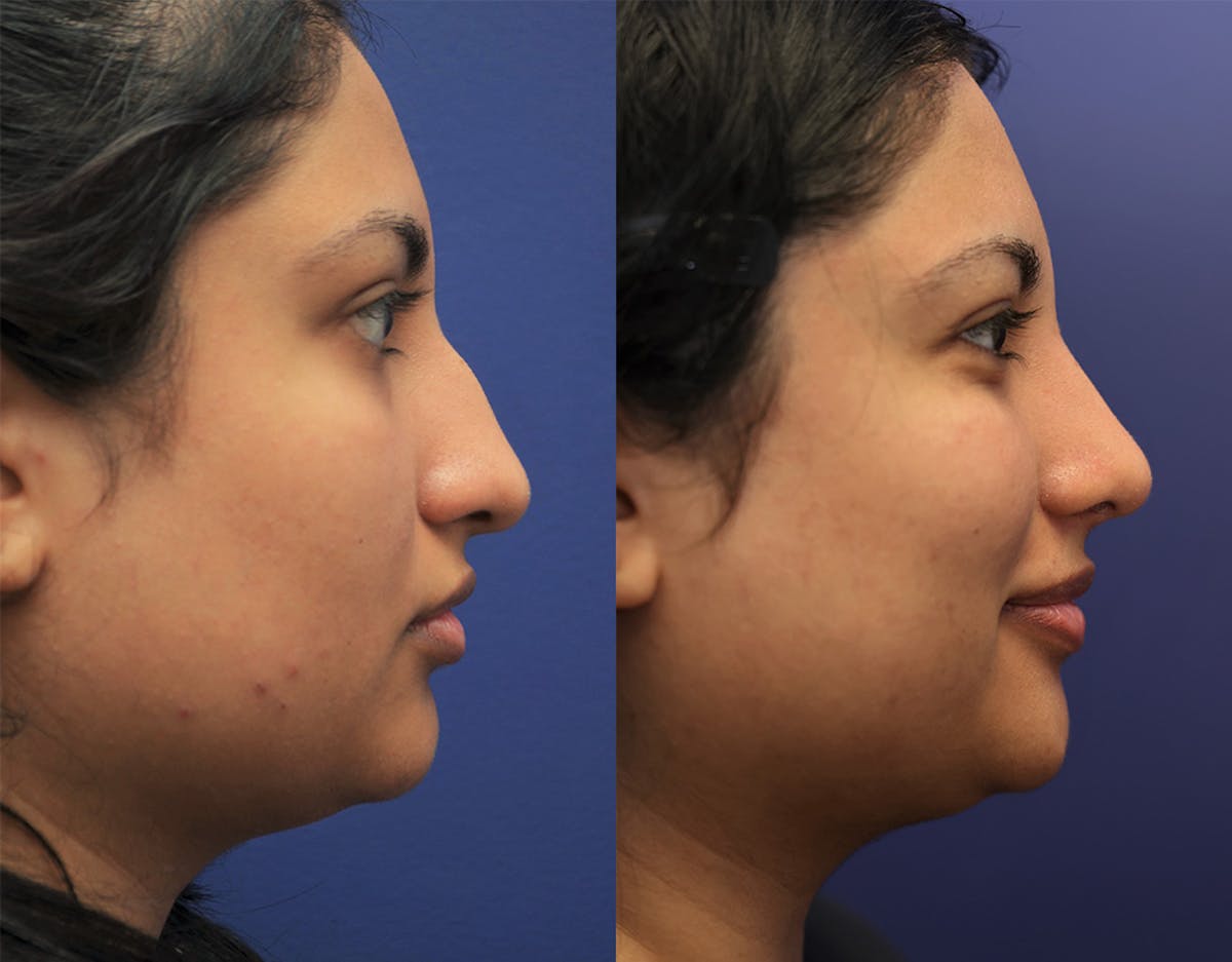 Rhinoplasty Before & After Gallery - Patient 276432 - Image 2