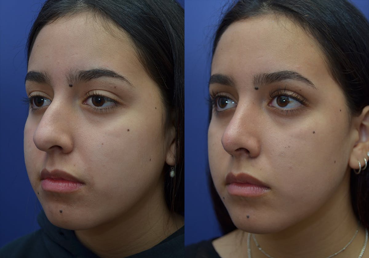 Rhinoplasty Before & After Gallery - Patient 740112 - Image 1