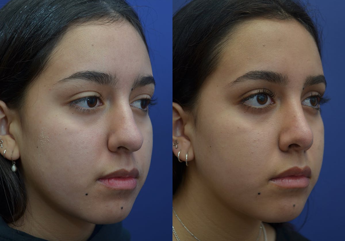 Rhinoplasty Before & After Gallery - Patient 740112 - Image 3