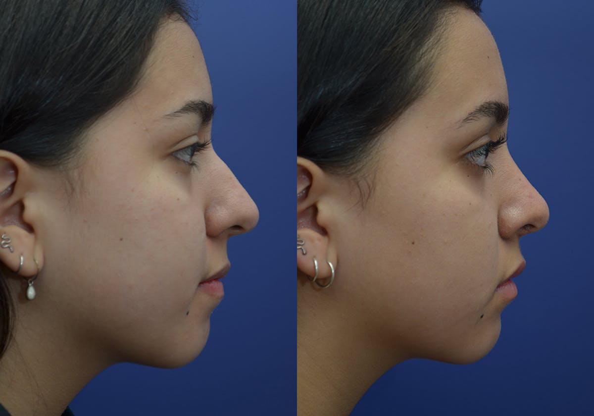 Rhinoplasty Before & After Gallery - Patient 740112 - Image 4