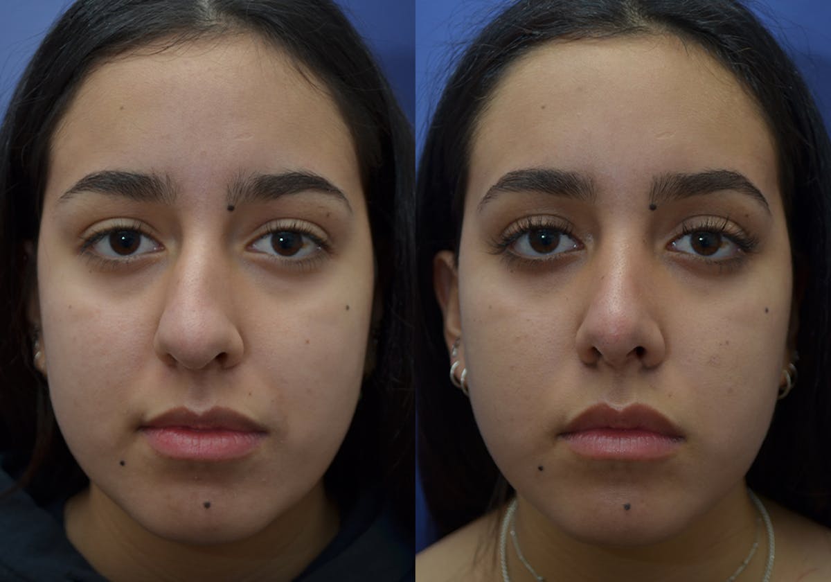 Rhinoplasty Before & After Gallery - Patient 740112 - Image 5