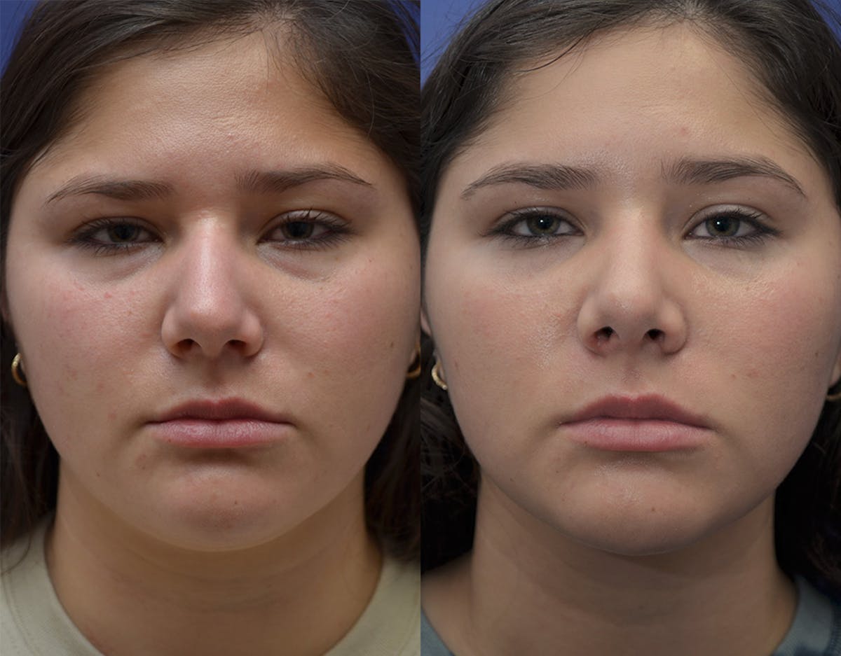 Rhinoplasty Before & After Gallery - Patient 287316 - Image 3