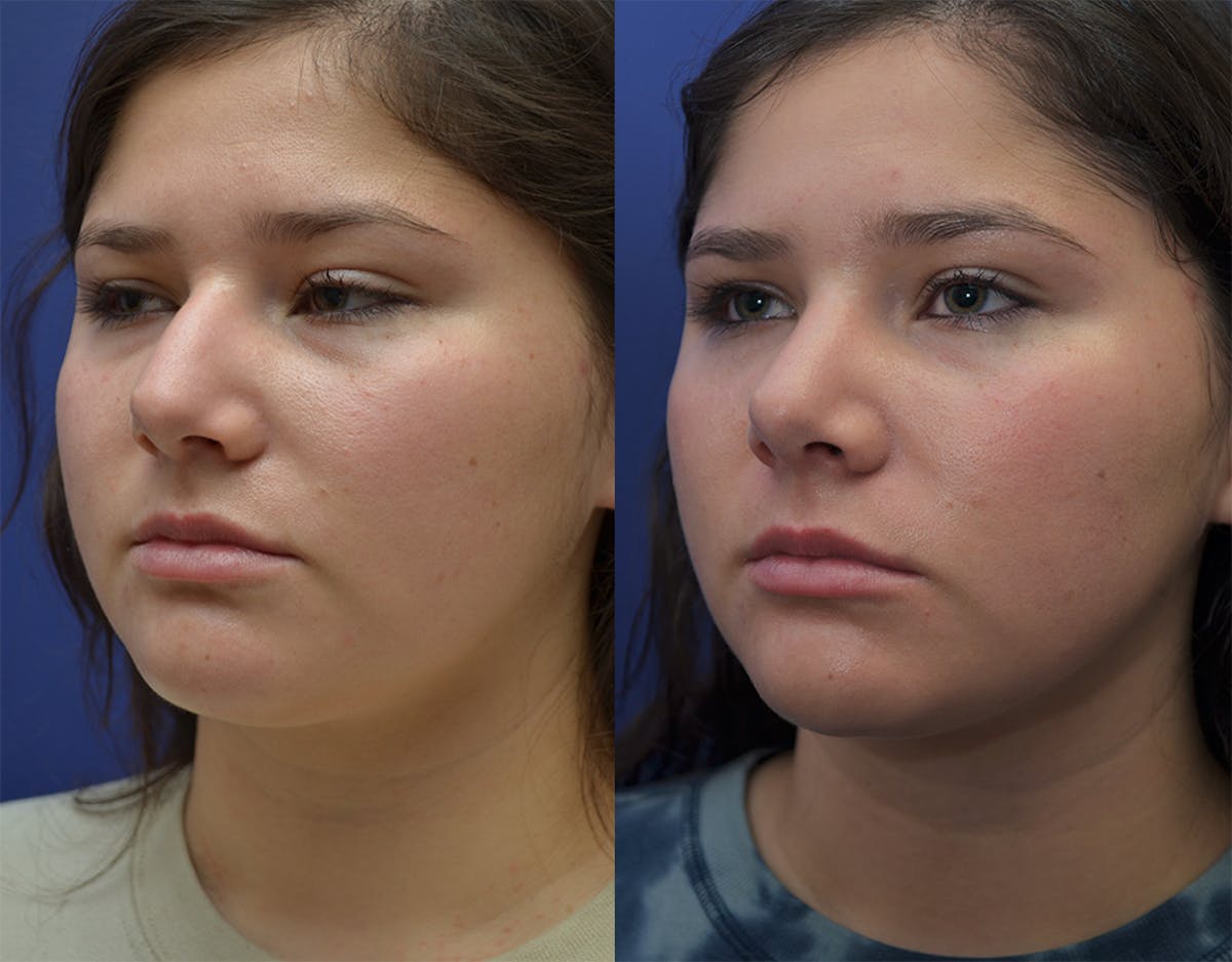 Rhinoplasty Before & After Gallery - Patient 287316 - Image 5