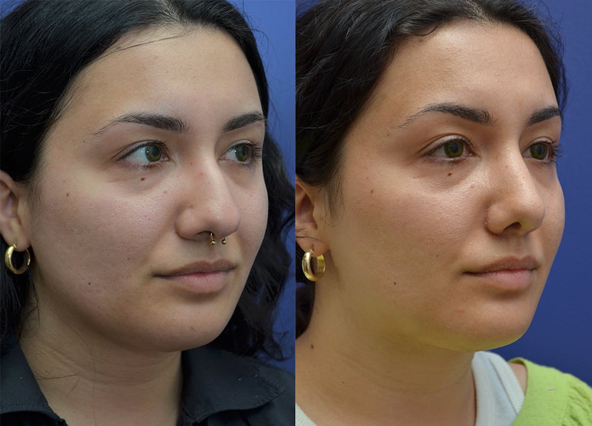 Rhinoplasty Before & After Gallery - Patient 339705 - Image 4