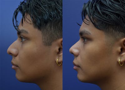 Rhinoplasty Before & After Gallery - Patient 192569 - Image 1