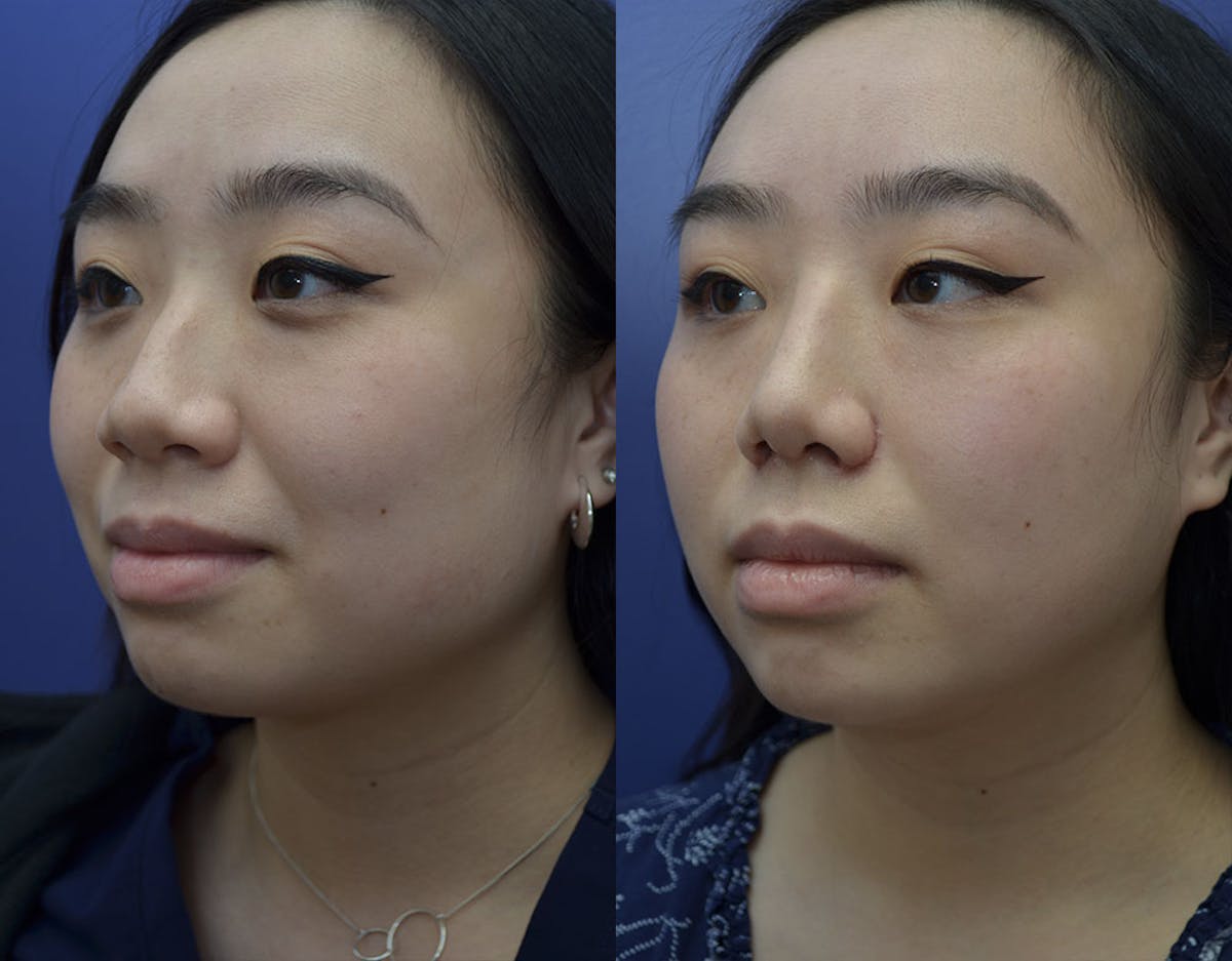 Rhinoplasty Before & After Gallery - Patient 110999 - Image 1