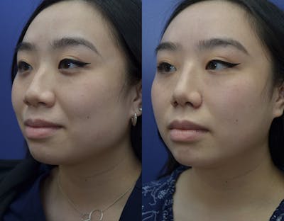 Rhinoplasty Before & After Gallery - Patient 110999 - Image 1