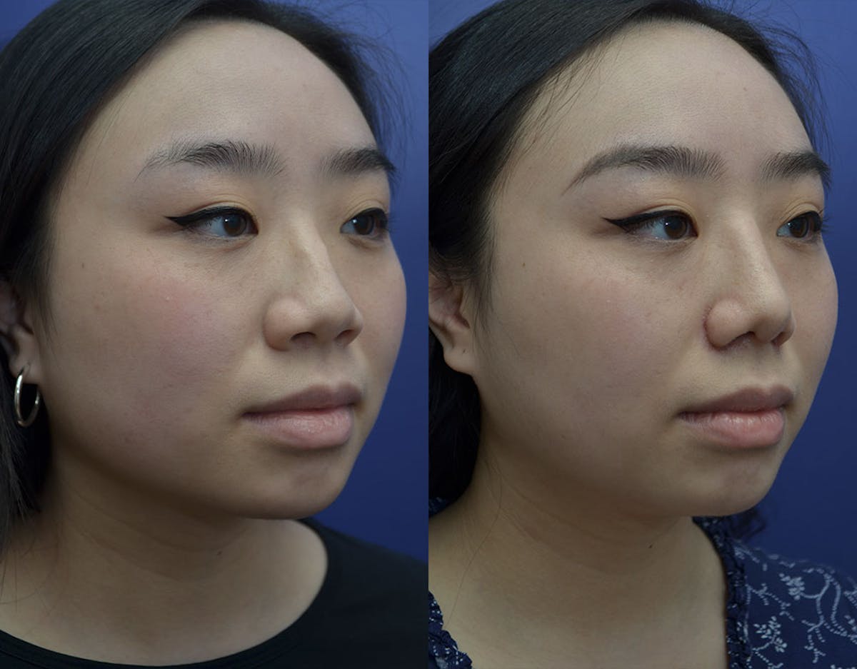 Rhinoplasty Before & After Gallery - Patient 110999 - Image 2