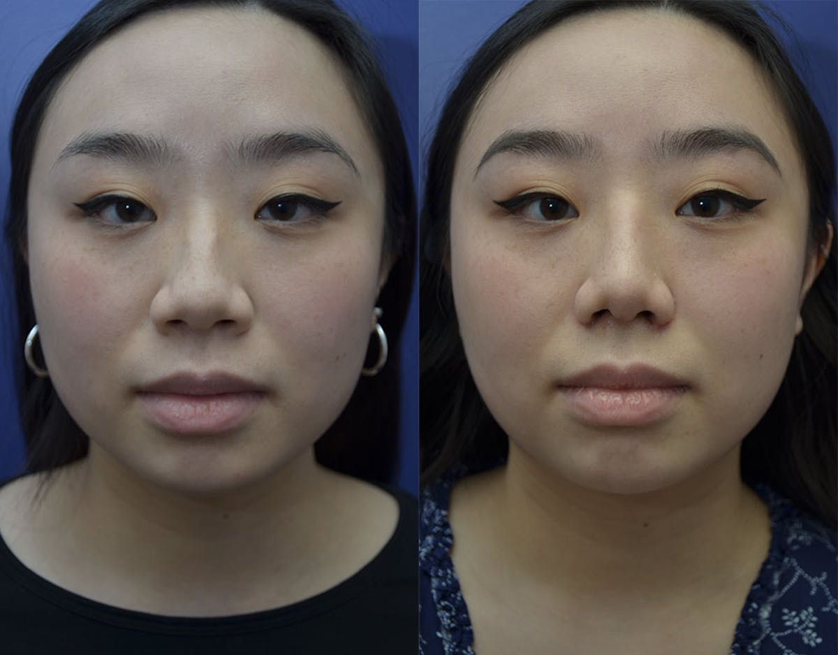 Rhinoplasty Before & After Gallery - Patient 110999 - Image 3
