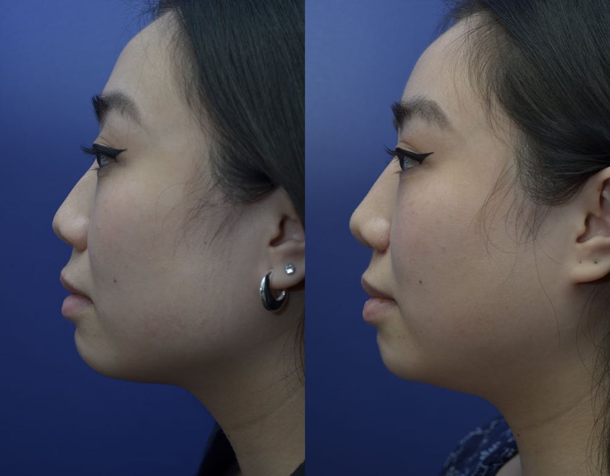 Rhinoplasty Before & After Gallery - Patient 110999 - Image 4
