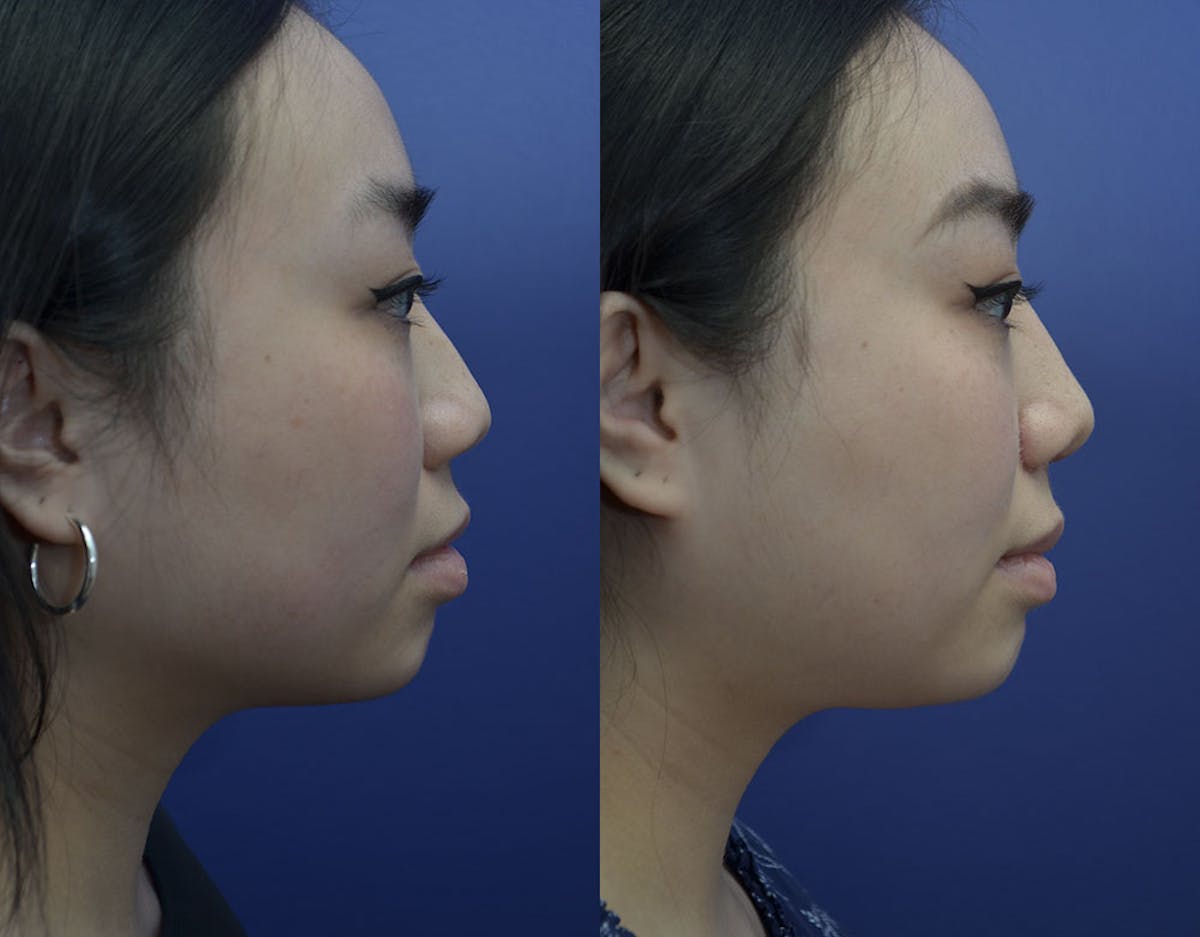 Rhinoplasty Before & After Gallery - Patient 110999 - Image 5