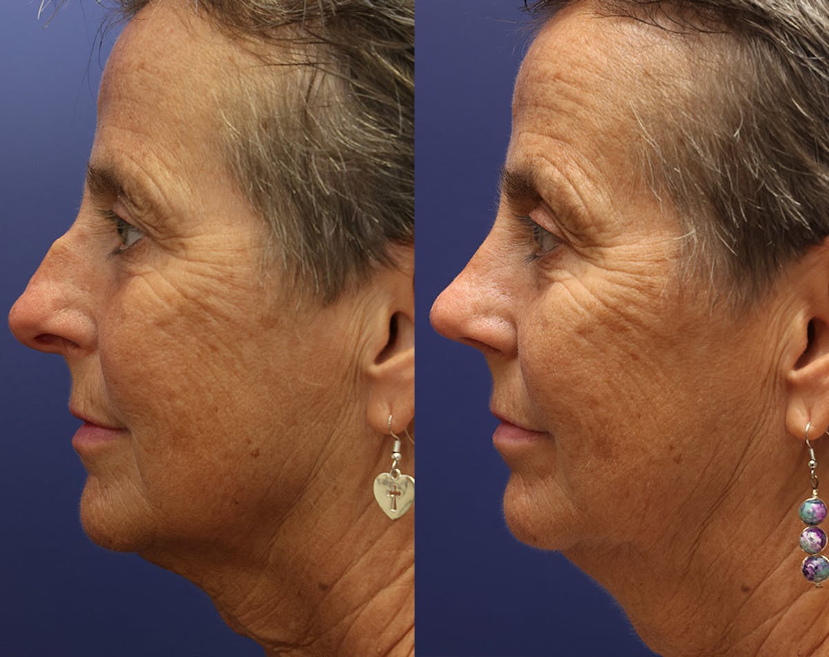 Rhinoplasty Before & After Gallery - Patient 358831 - Image 1