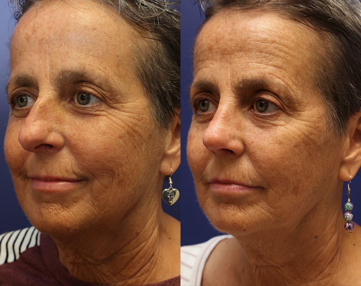 Rhinoplasty Before & After Gallery - Patient 358831 - Image 2
