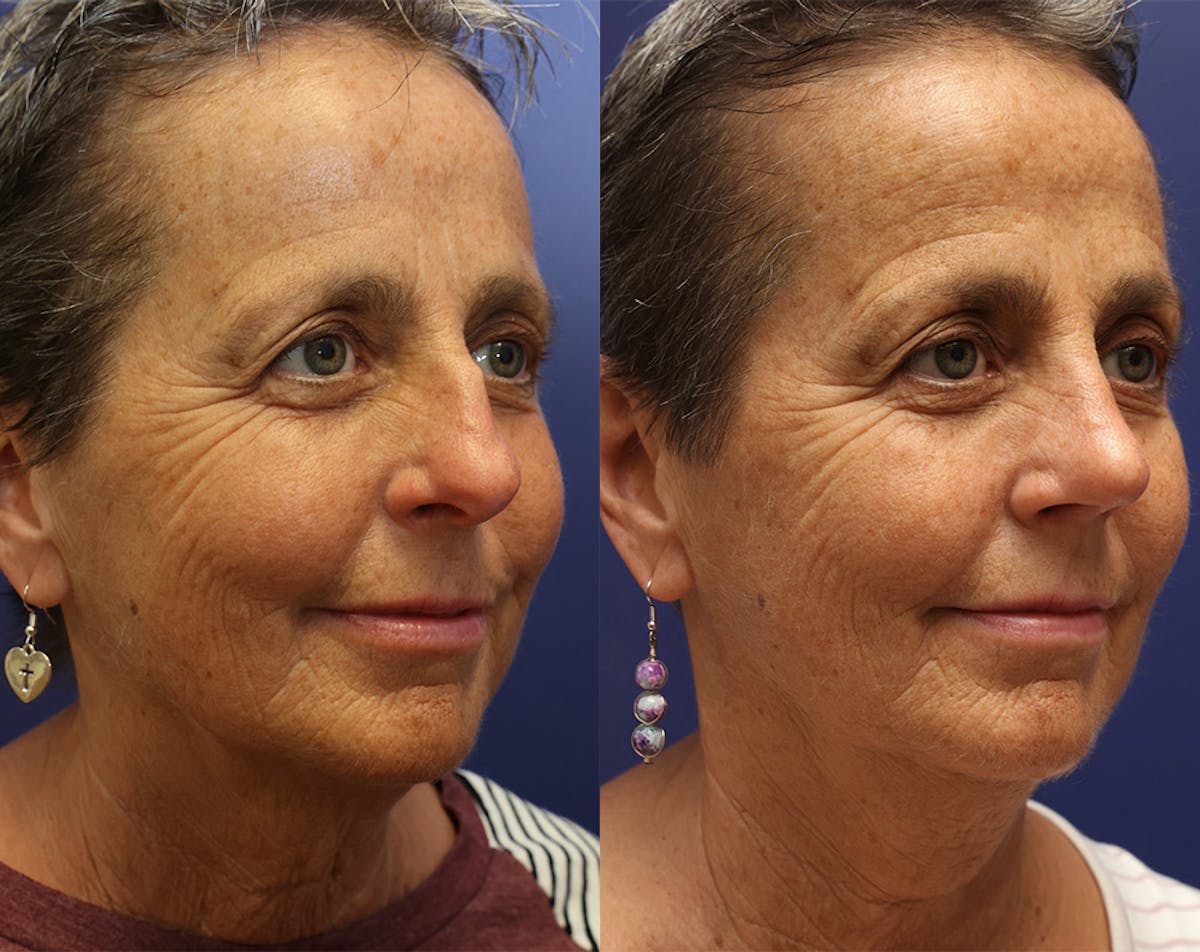 Rhinoplasty Before & After Gallery - Patient 358831 - Image 3