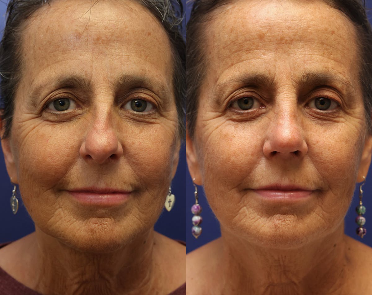 Rhinoplasty Before & After Gallery - Patient 358831 - Image 4