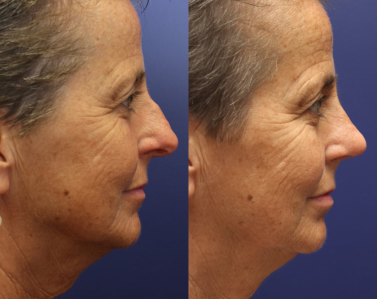 Rhinoplasty Before & After Gallery - Patient 358831 - Image 5