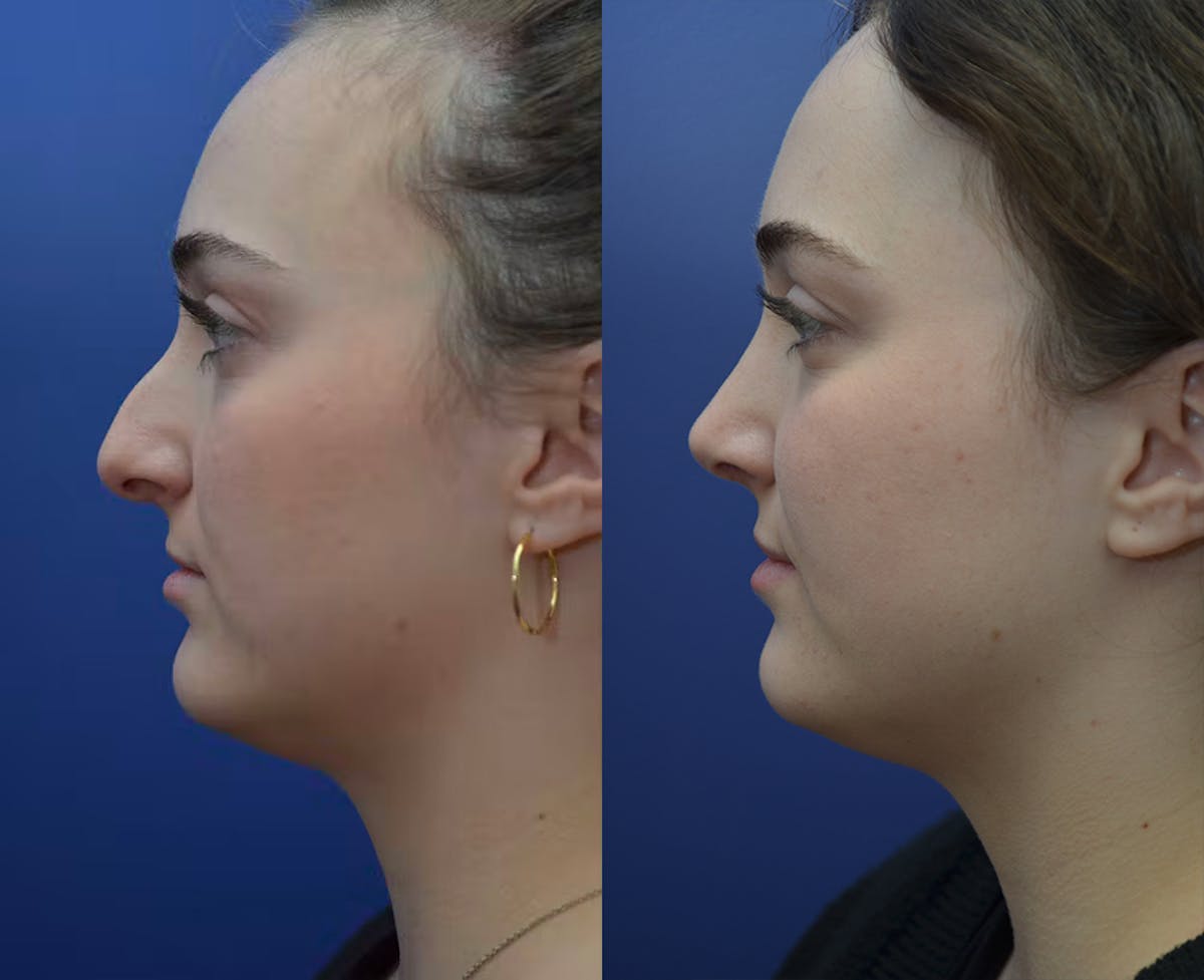 Rhinoplasty Before & After Gallery - Patient 559345 - Image 1