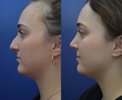 Rhinoplasty Before & After Gallery - Patient 559345 - Image 1