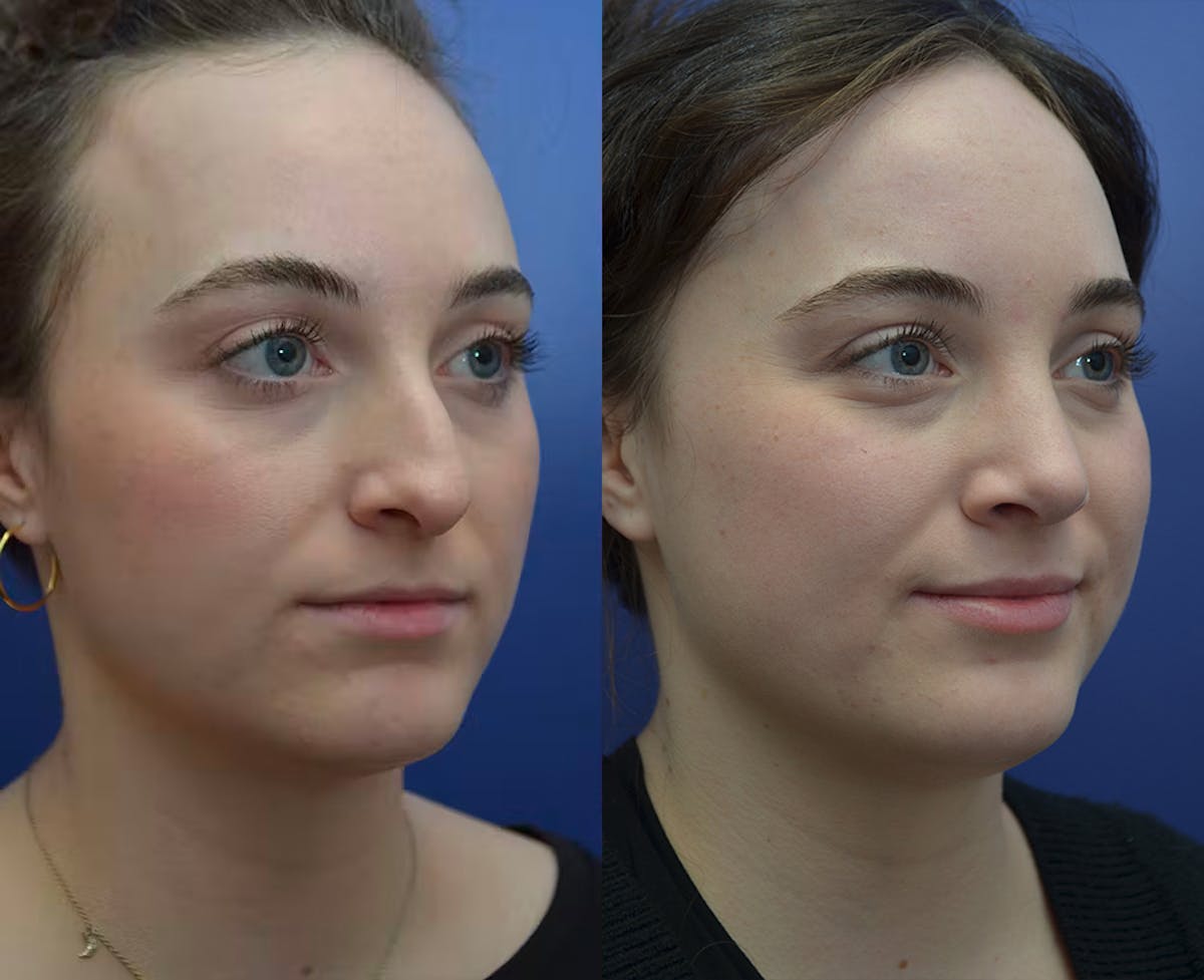 Rhinoplasty Before & After Gallery - Patient 559345 - Image 3