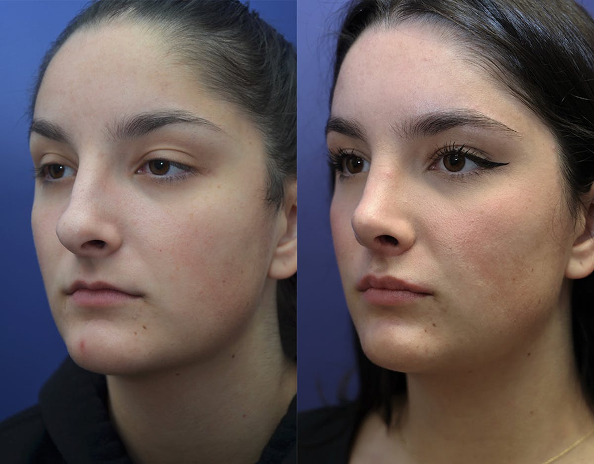 Lip Augmentation Before & After Gallery - Patient 375358 - Image 2